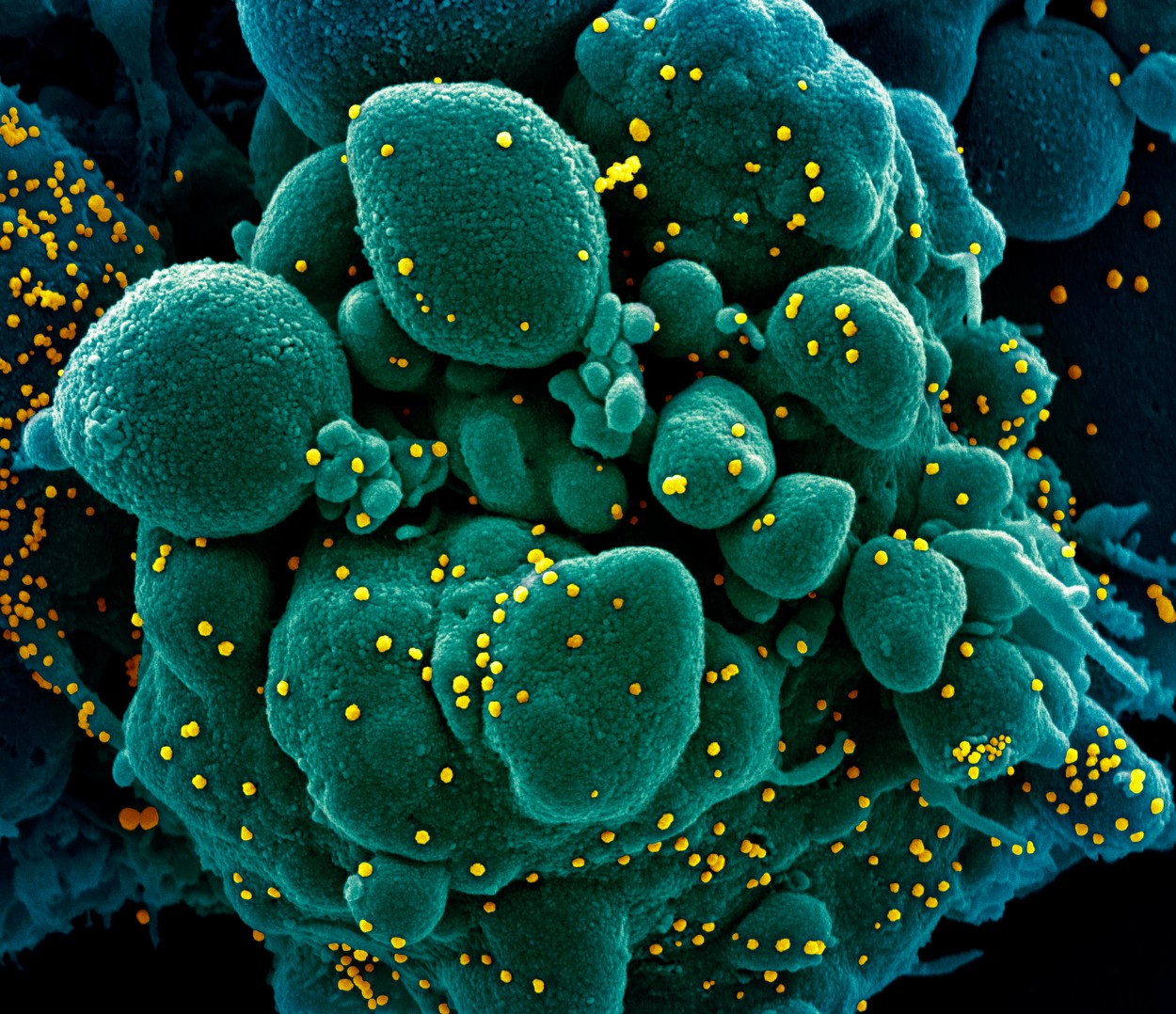Cell infected with Covid-19 coronavirus particles. Coloured scanning electron micrograph (SEM) of SARS-CoV-2 coronavirus particles (yellow) on an apoptotic cell (green) from a patient sample. SARS-CoV-2 (previously 2019-nCoV) was first identified in Wuhan, China, in December 2019, and has been declared a pandemic. It is an enveloped RNA (ribonucleic acid) virus. It causes Covid-19, a respiratory infection that can lead to fatal pneumonia. As of March 2020, over 200,000 have been infected worldwide with thousands of deaths. Social restrictions and infection control measures have been put in place to slow the spread of the virus. This sample was imaged at the NIAID (National Institute of Allergy and Infectious Diseases) Integrated Research Facility (IRF) in Fort Detrick, Maryland, USA., Image: 513606872, License: Rights-managed, Restrictions: , Model Release: no, Credit line: Science Photo Library / Sciencephoto / Profimedia