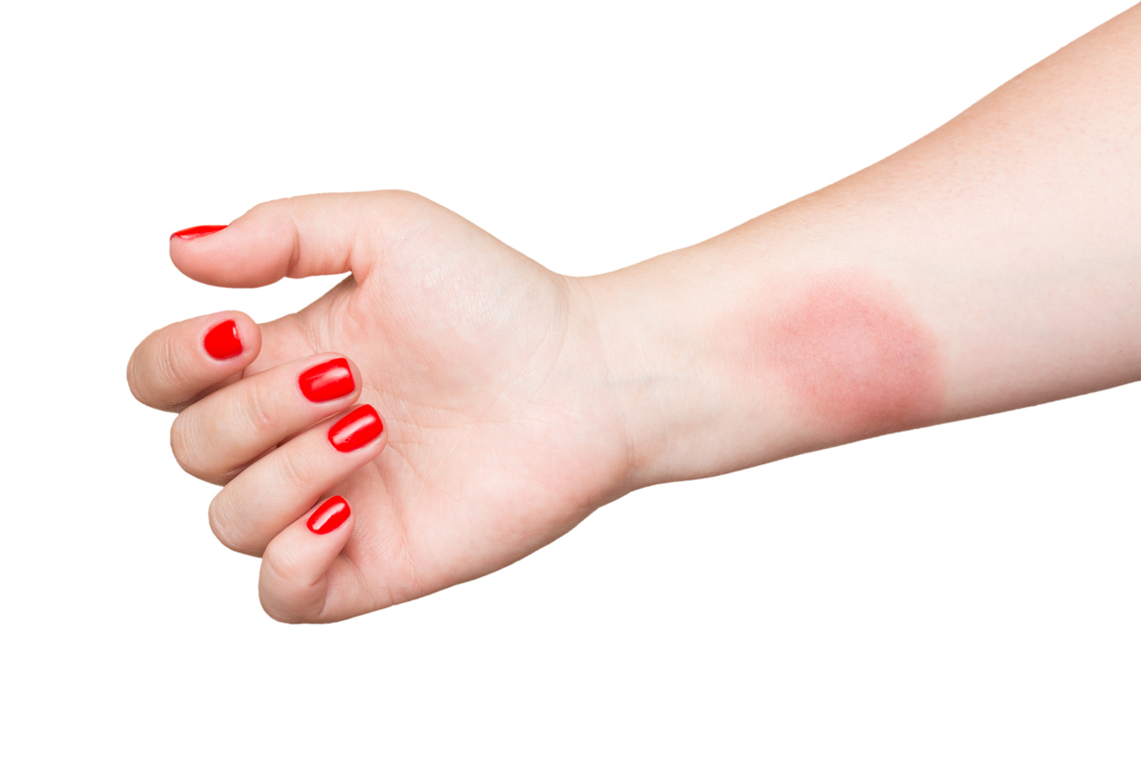 Burn on female hand with red nails isolated on white background