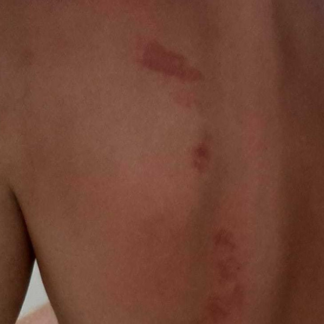 Ozljede na Nijemcu uhićenom u Omišu