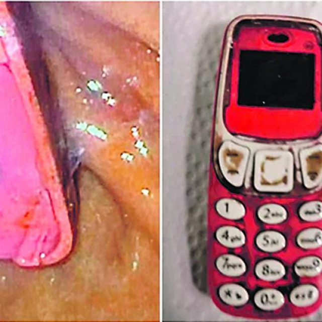 Nokia 3310 izvučena iz želuca pacijenta u Prištni