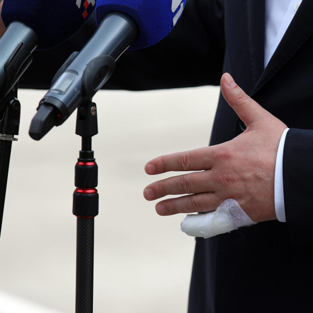 &lt;p&gt;Ozlijeđeni prst predsjednika Milanovića&lt;/p&gt;