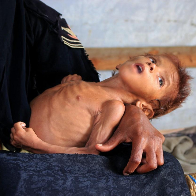 &lt;p&gt;Gladno dijete u Jemenu&lt;/p&gt;