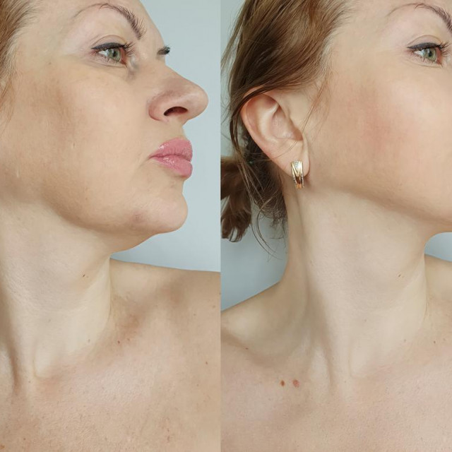 &lt;p&gt;woman double chin after treatment&lt;/p&gt;