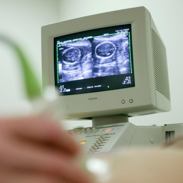 &lt;p&gt;Ilustracija, ultrazvuk tijekom trudnoće&lt;/p&gt;