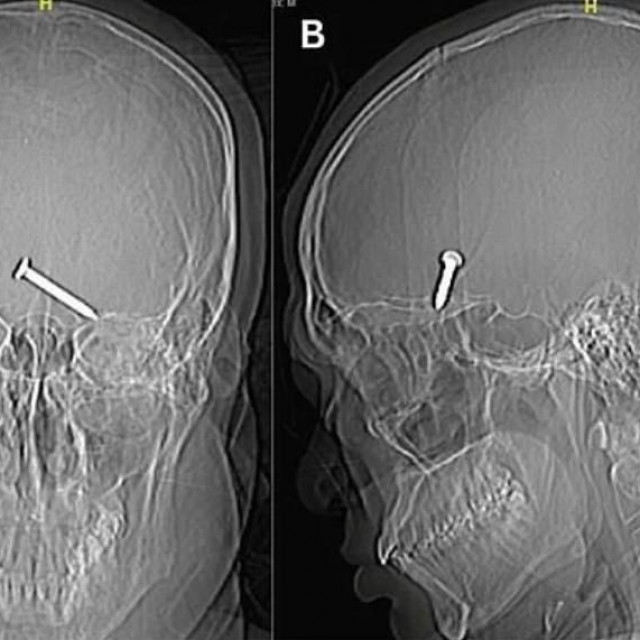 &lt;p&gt;Prikaz glave pacijenta koji je slučajno ispalio pištolj za čavle u oko&lt;/p&gt;