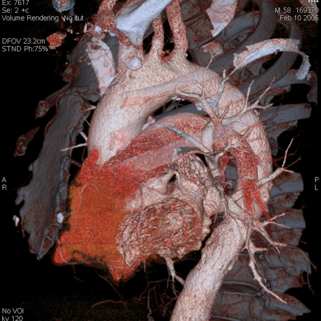 Aorta, 3D scann
